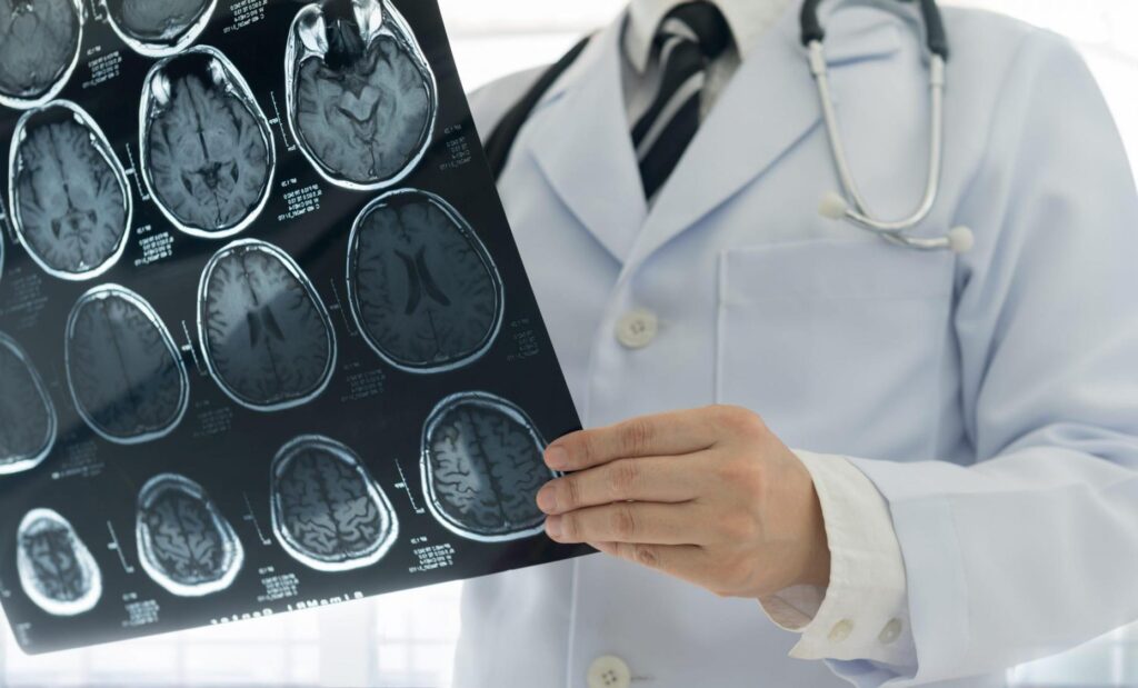 Doctor revisando tomografía cerebral, después de un ataque epiléptico  