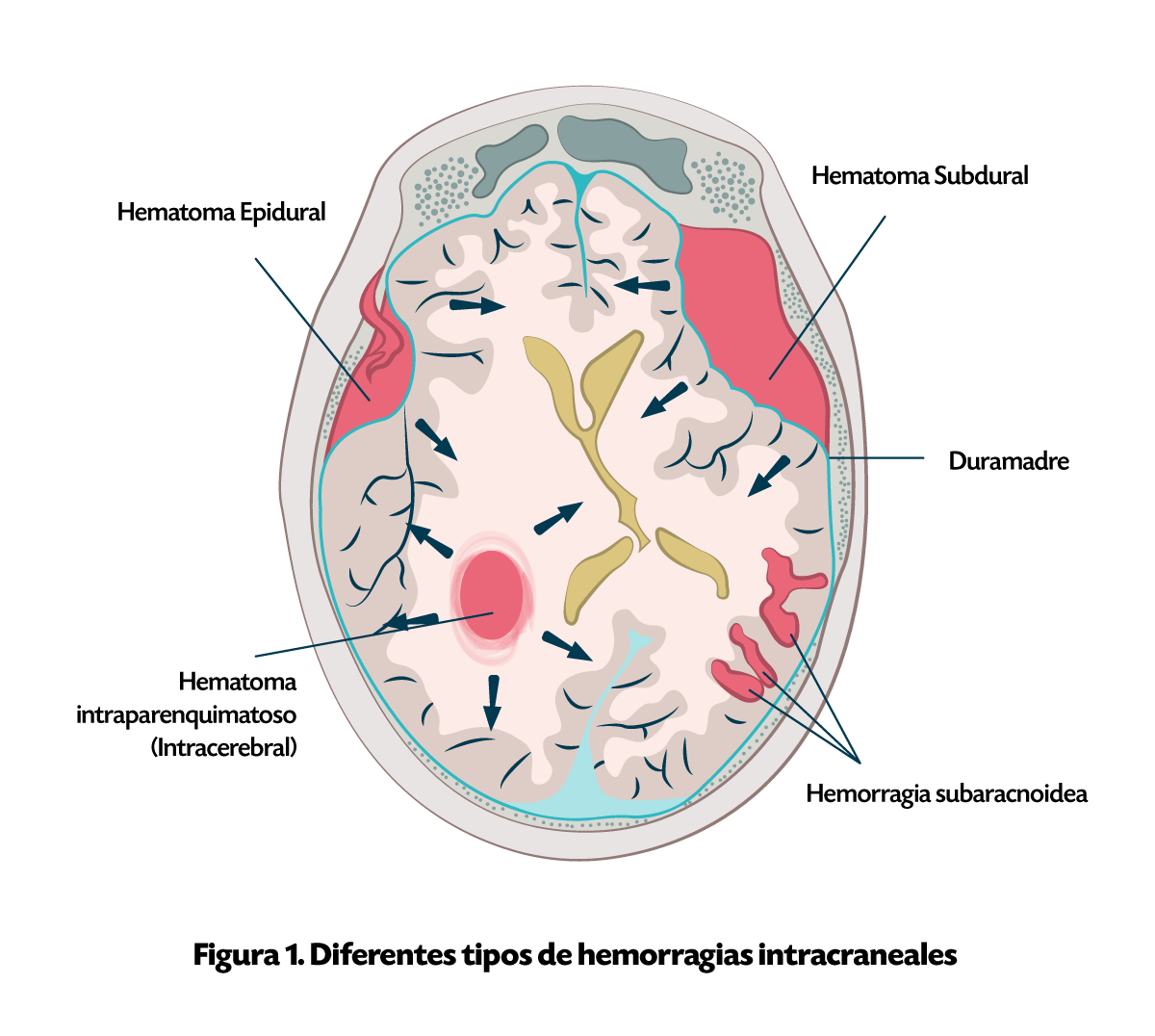 Inflamación Asociada al EVC hemorrágico