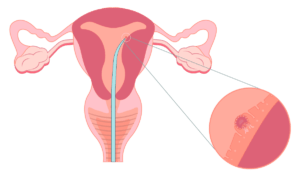 Implantación